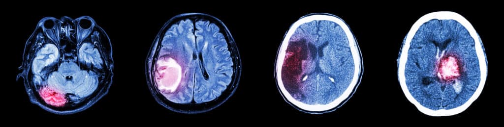 emorragia intracerebrale