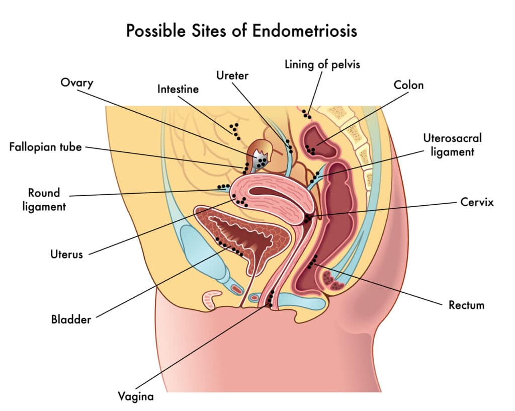 endometriosi