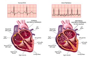 fibrillazione atriale