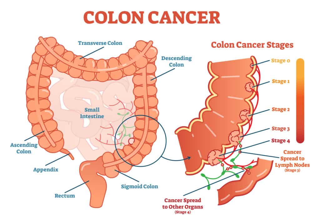 Cancro al colon-retto