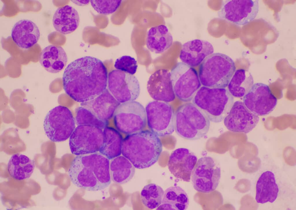 leucemia mielomonocitica cronica