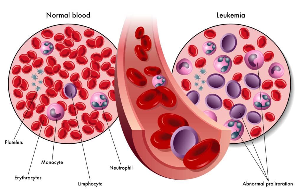 leucemia mielomonocitica cronica