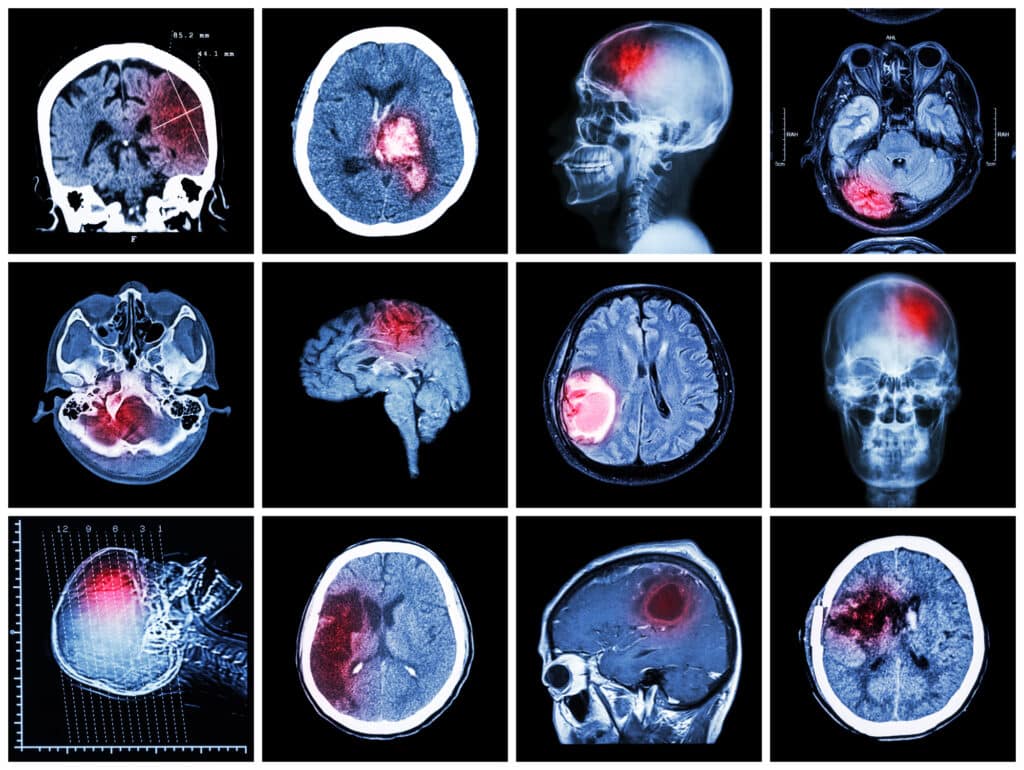 glioblastoma