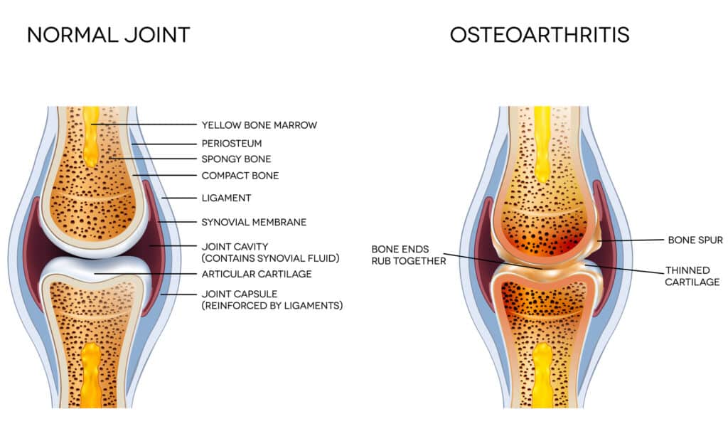 Osteoartrite 