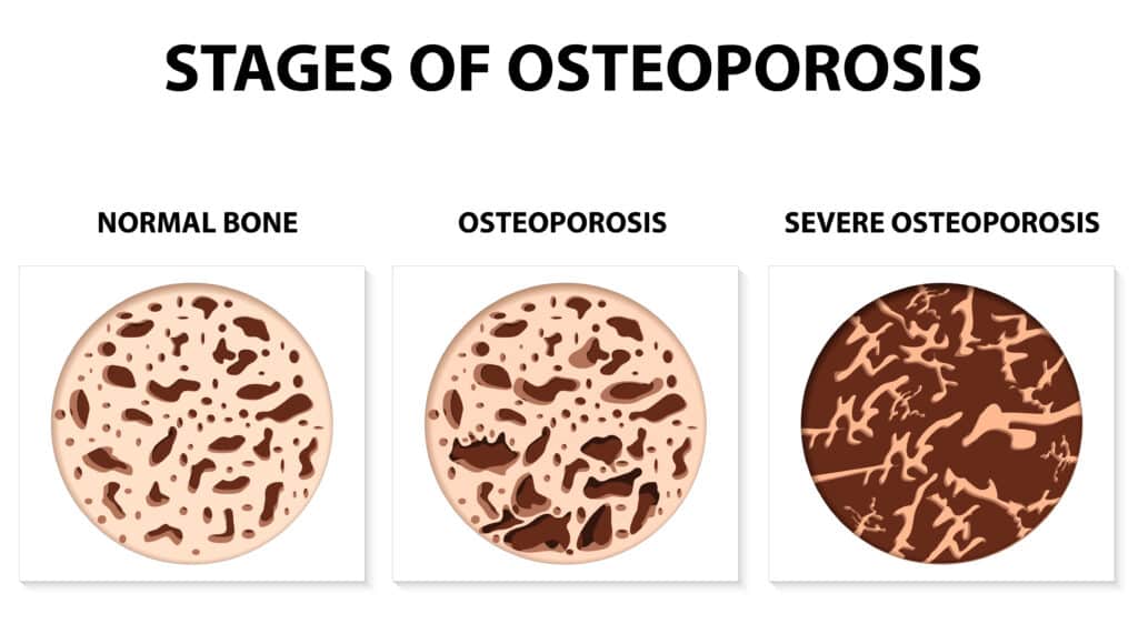 osteoporosi