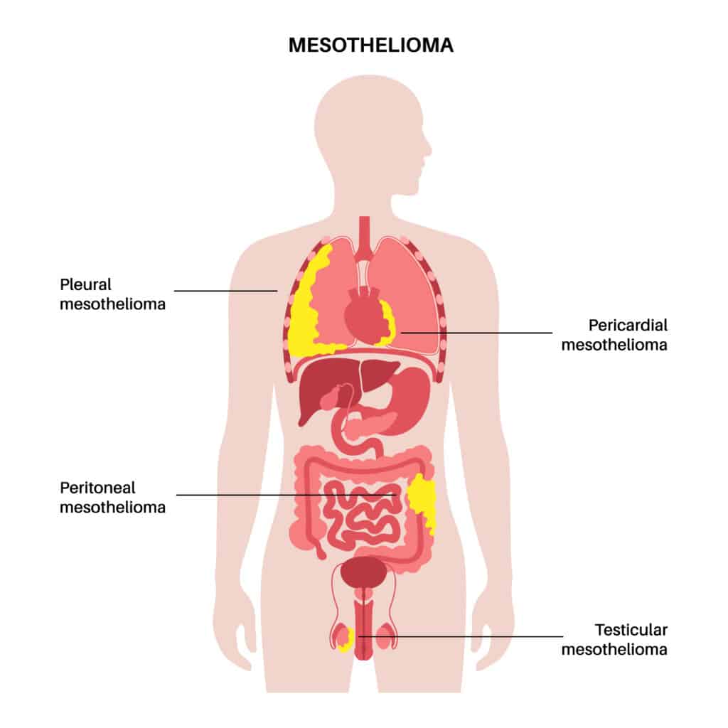 mesotelioma