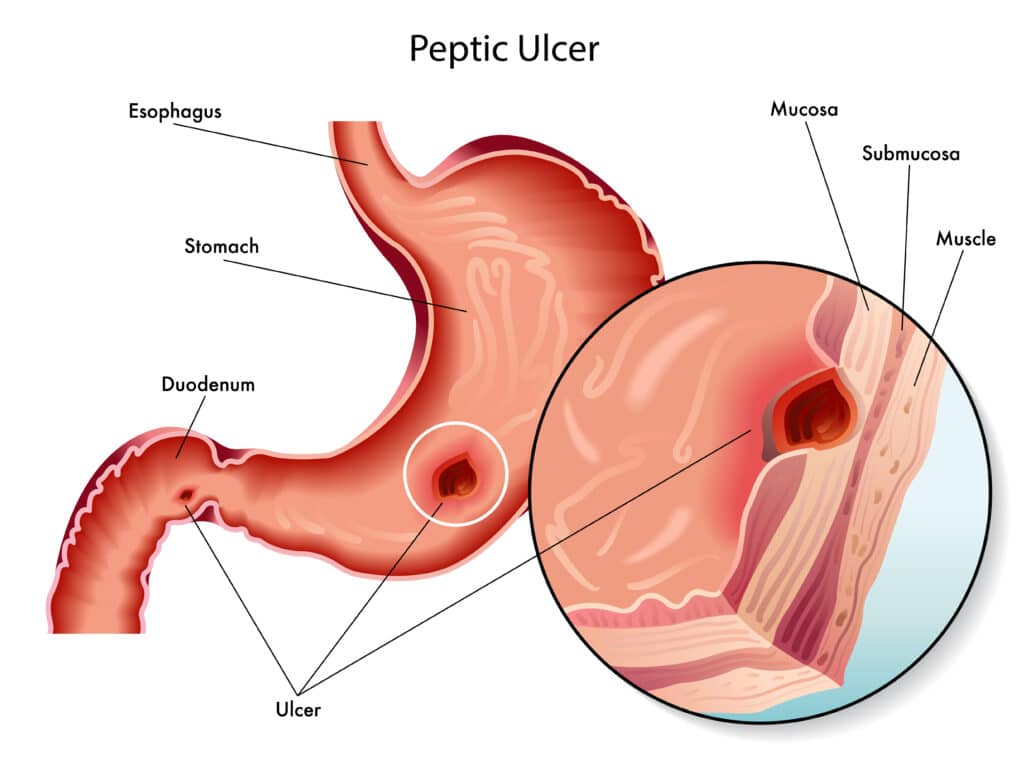 ulcere gastriche