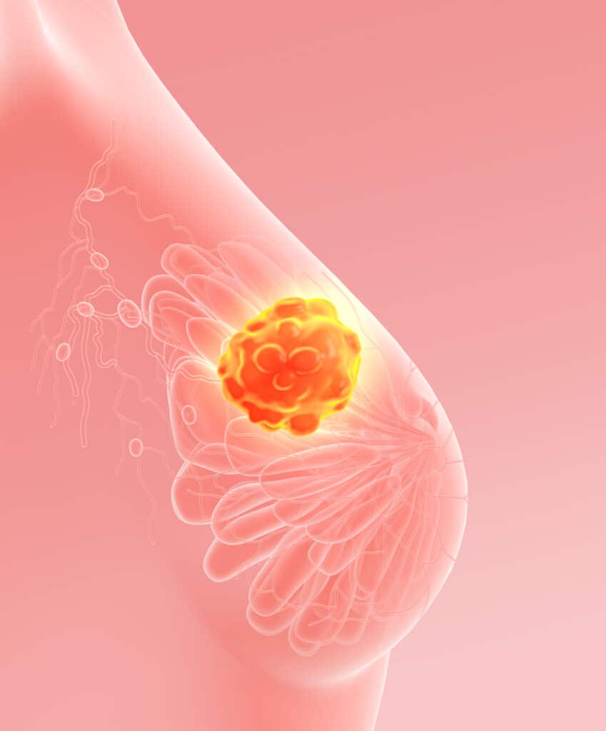 Carcinoma mammario triplo negativo  linfonodale