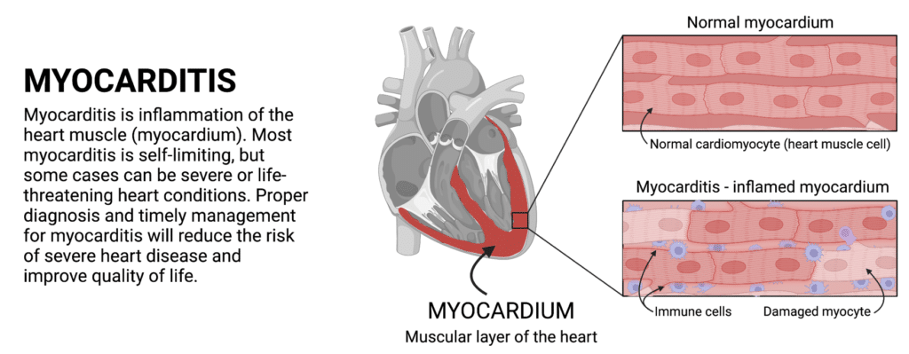 Cos'è la miocardite - Credits: University of California