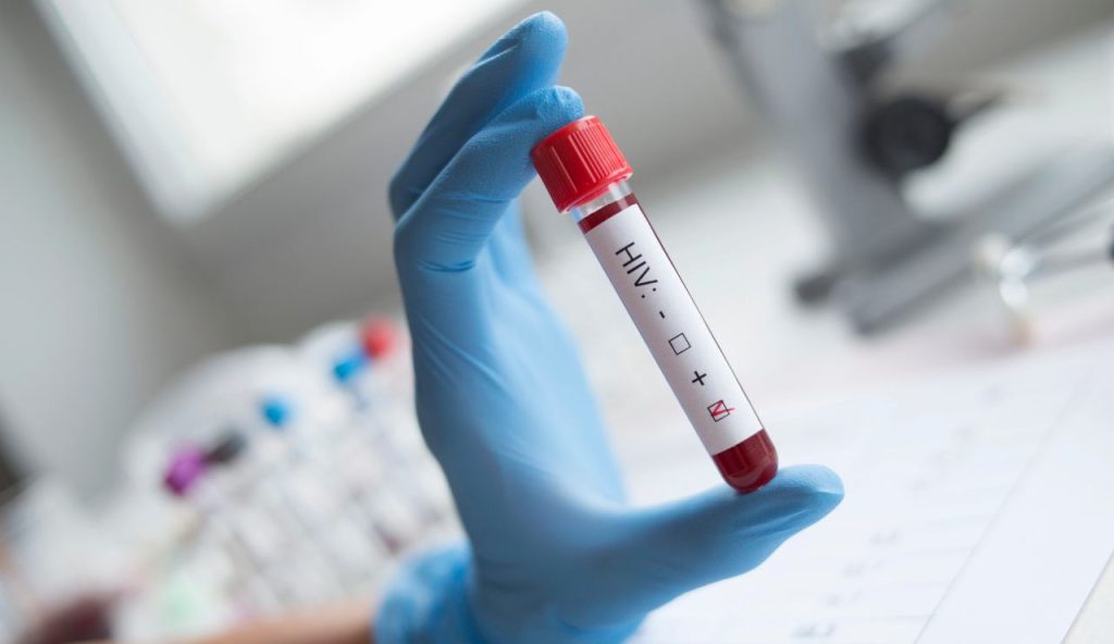 Il test dell'HIV