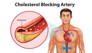 Illustrazione del colesterolo nelle arterie (Depositphotos)