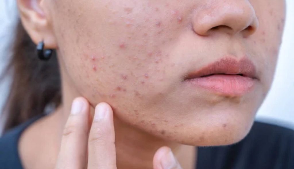 Ragazza con l'acne