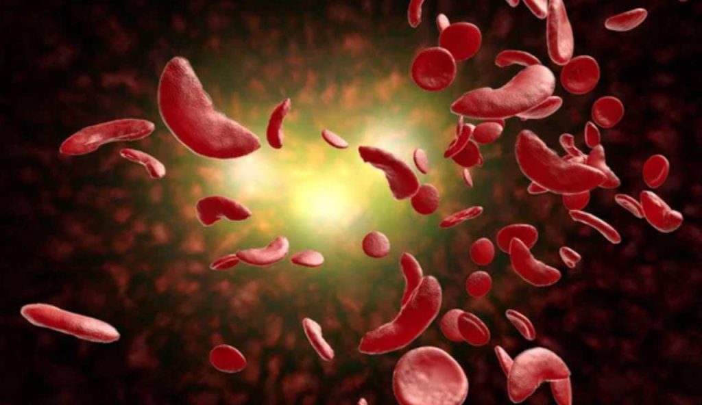 Anemia falciforme (Depositphotos foto)