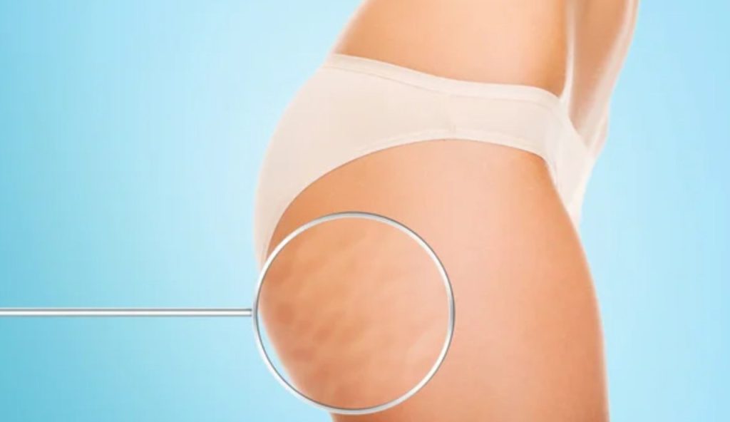 Cellulite e rimedi (Depositphotos foto)